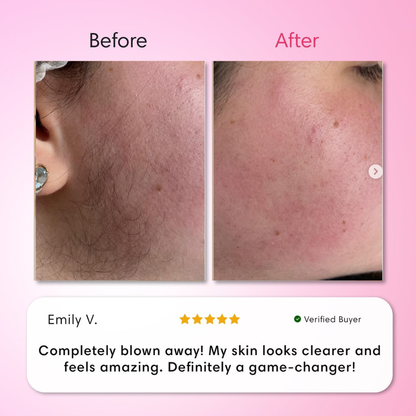 Hair Removal Trilogy Kit