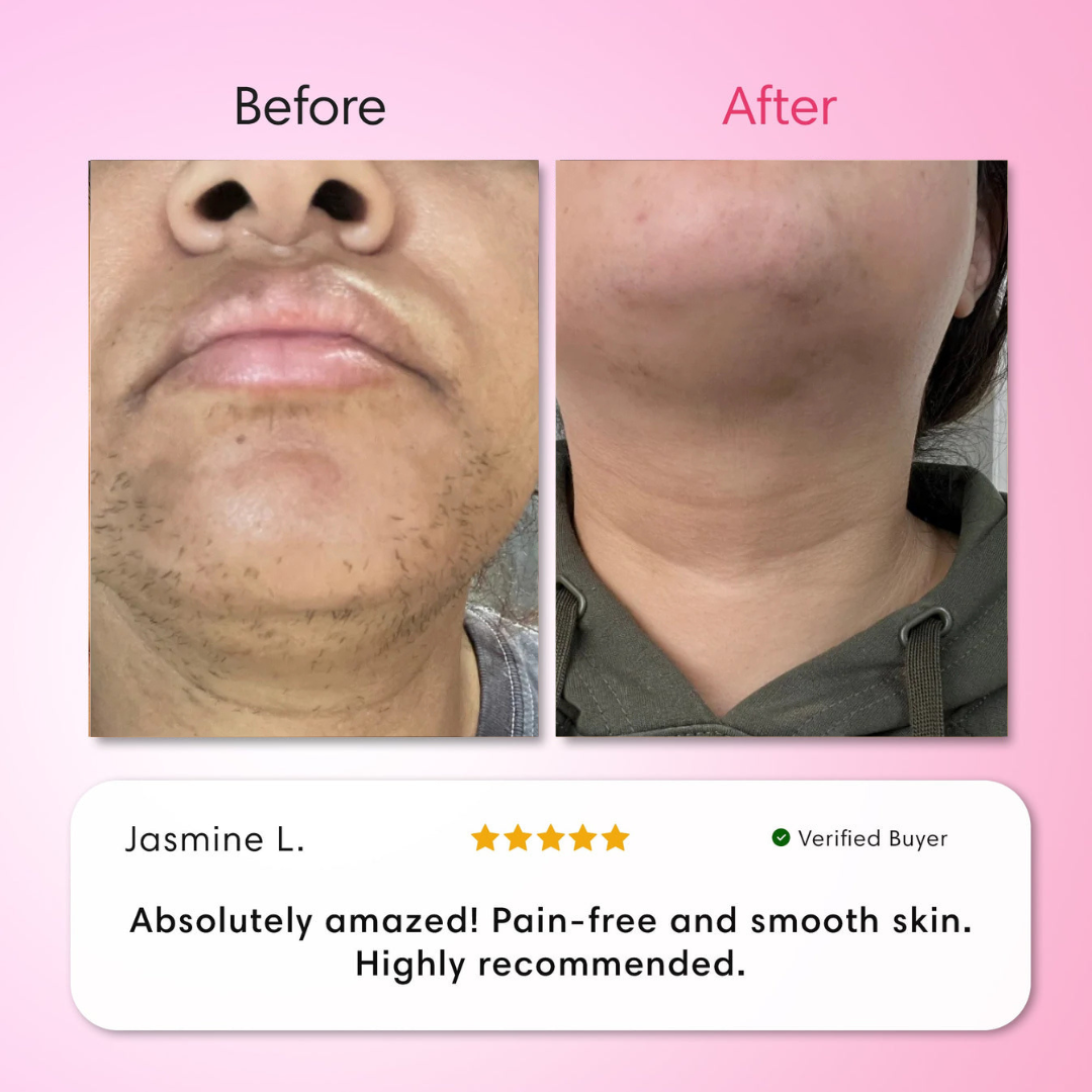 Hair Removal Trilogy Kit