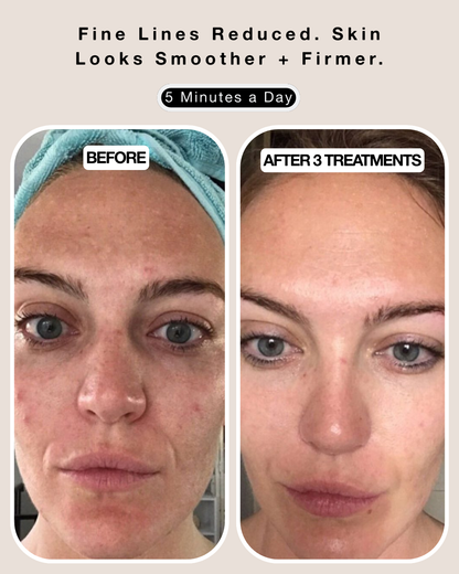 nelle® micro infusion system